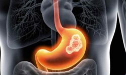 کاهش وزن ناگهانی و زردی پوست؛ علائم هشدار سرطان لوزالمعده