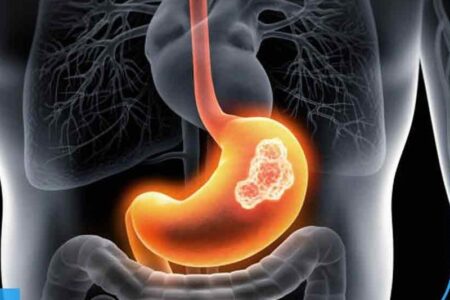 کاهش وزن ناگهانی و زردی پوست؛ علائم هشدار سرطان لوزالمعده