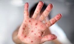 آغاز طرح تکمیلی واکسیناسیون سرخک در استان کرمان